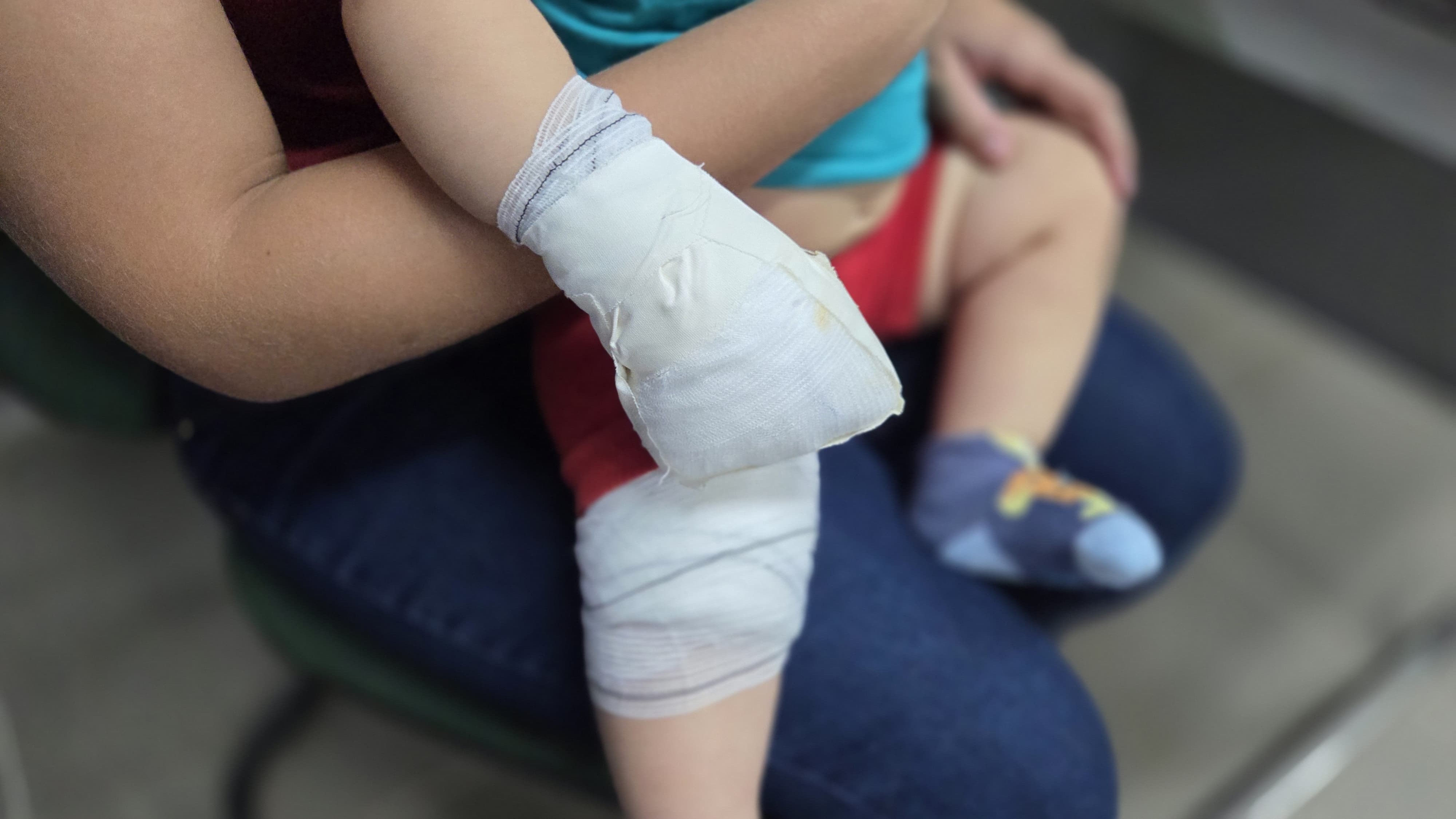 a imagem mostra as mãos de uma criança enfaixadas, ela está no colo da mãe, mas não aparecem os rostos das duas, apenas o detalhe